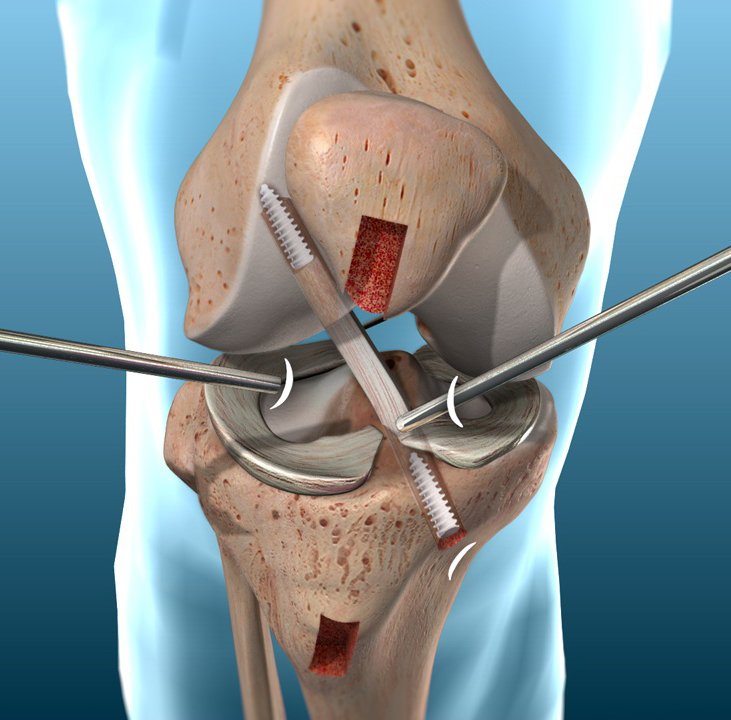 Arthroscopic Ligament Reconstruction