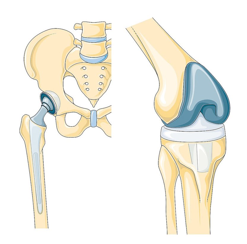 Knee & Hip Replacement